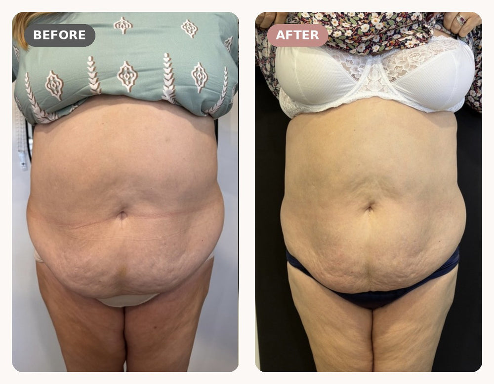 Client stomach before and after, front